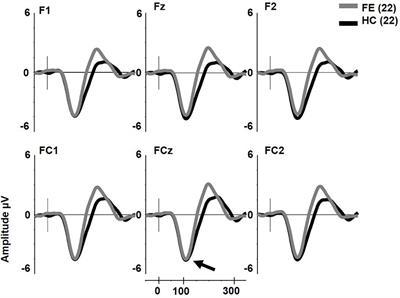 Reductions in Complex Mismatch Negativity to Extra Tone Gestalt Pattern Deviance in First-Episode Schizophrenia